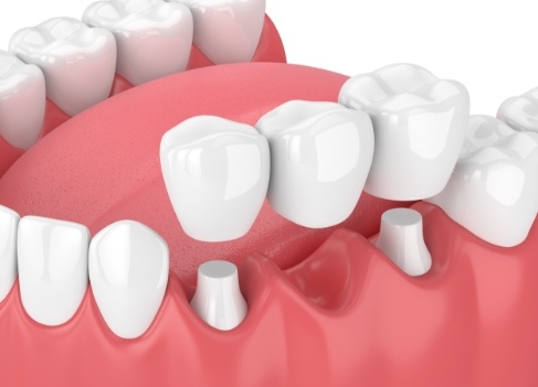 Animated smile during dental crown supported bridge placement