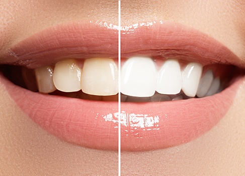 Patient in Anaheim smiling after teeth whitening